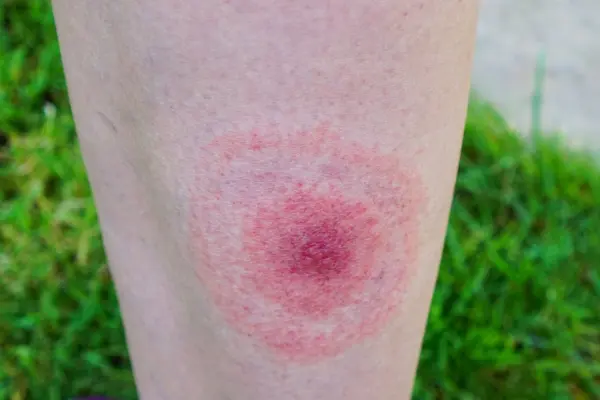 Νόσος Lyme: Όλα όσα πρέπει να γνωρίζετε